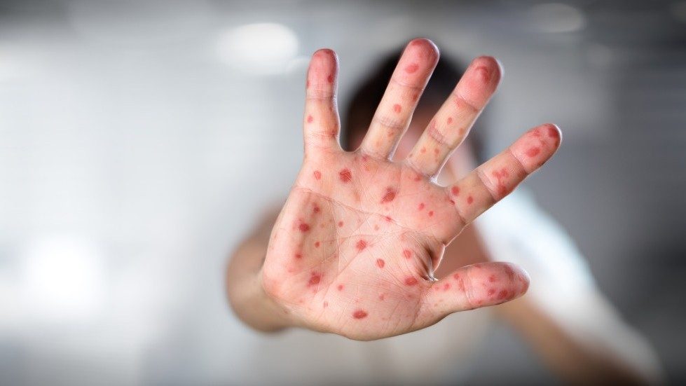 UNICEF Reports 3,000-Fold Increase in Measles Cases in Europe and Central Asia